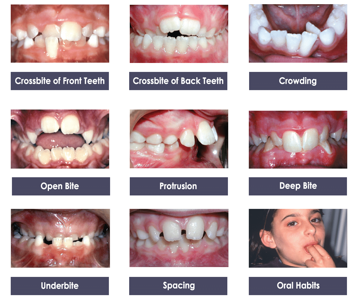 braces, Crowding Crossbite Open bite Protursion Deep Bite Underbite Spacing Oral habits